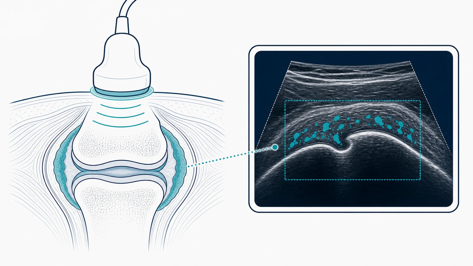 Schematic ultrasound showing synovial thickening with Doppler flow in an inflamed joint